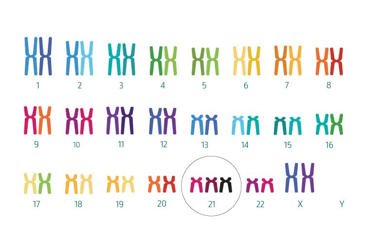 Trisomia 21 (sindrome di Down)