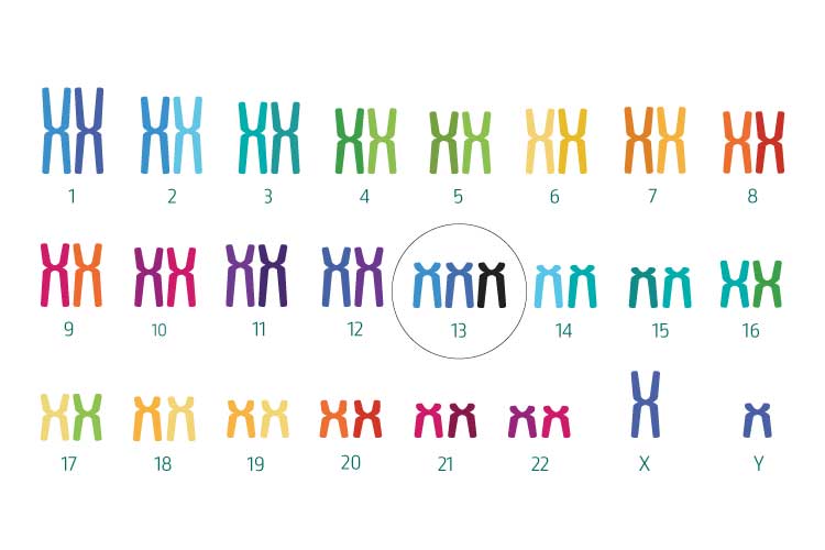 Trisomia 13 (sindrome di Patau)